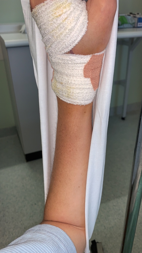 A bandaged hand in a pillow case used as a sling on a hospital ward to help keep the injured hand elevated
