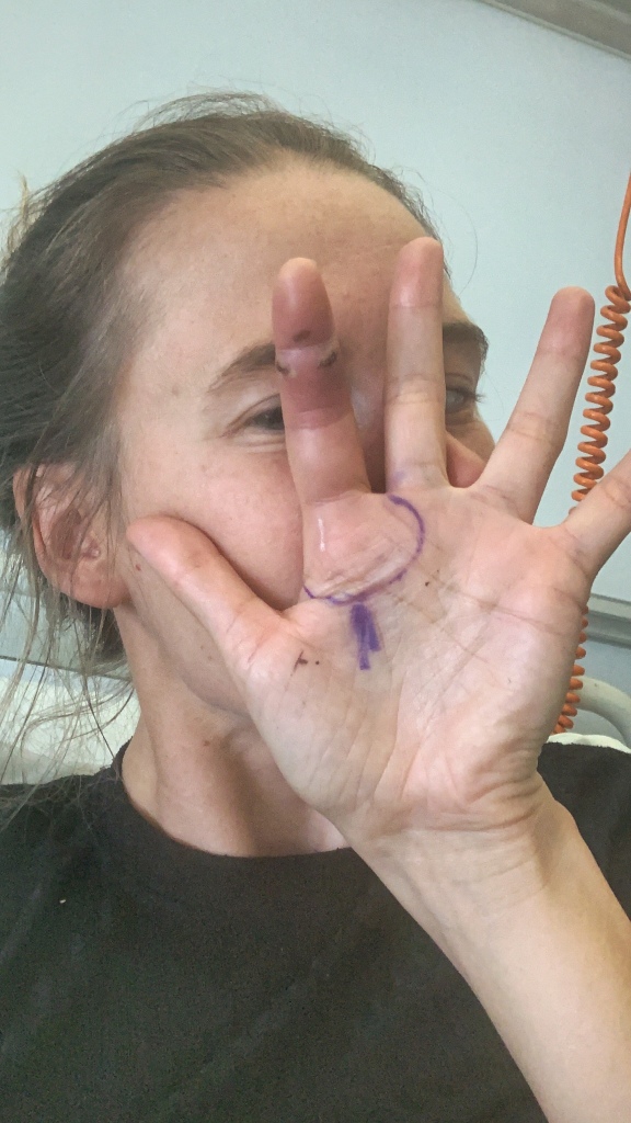 A girl showing her swollen index finger with 2 small puncture wounds