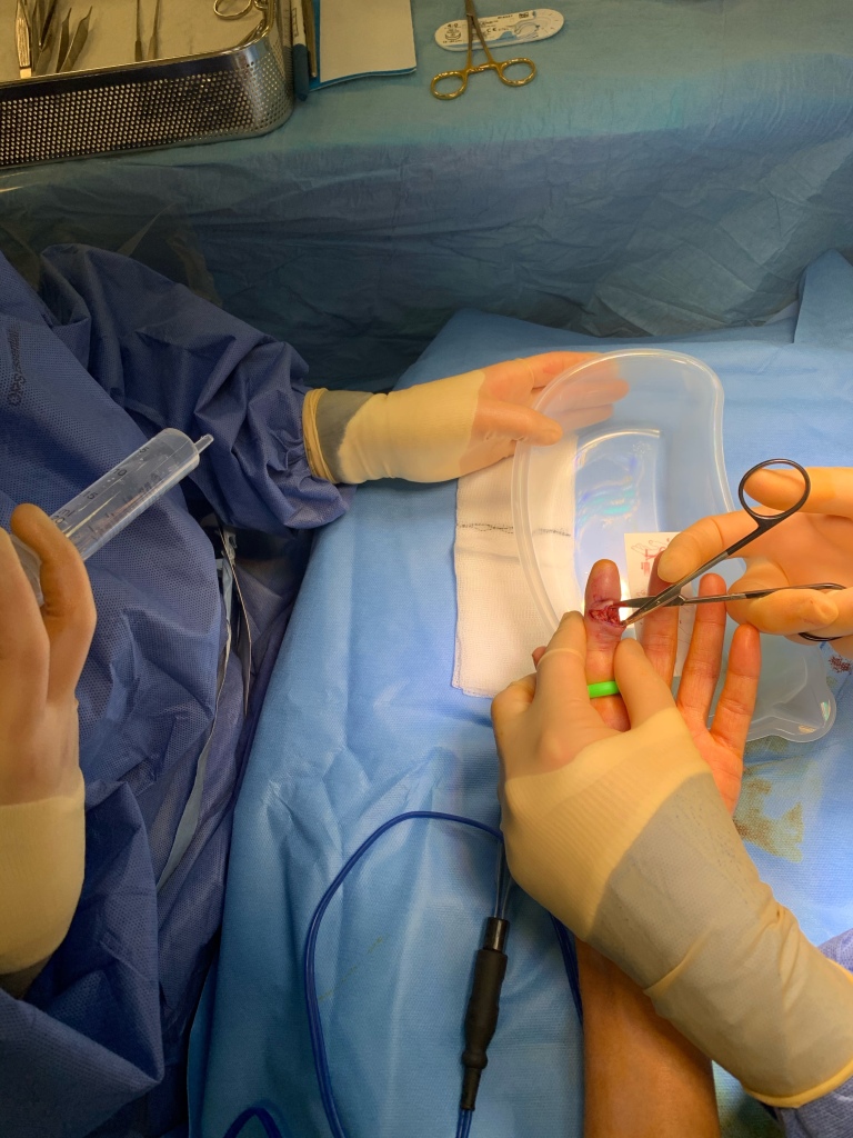 An injured finger being aseptically opened up with a pair of scissors under local anaesthetic in theatre and an assistant preparing to flush the wound with sterile water