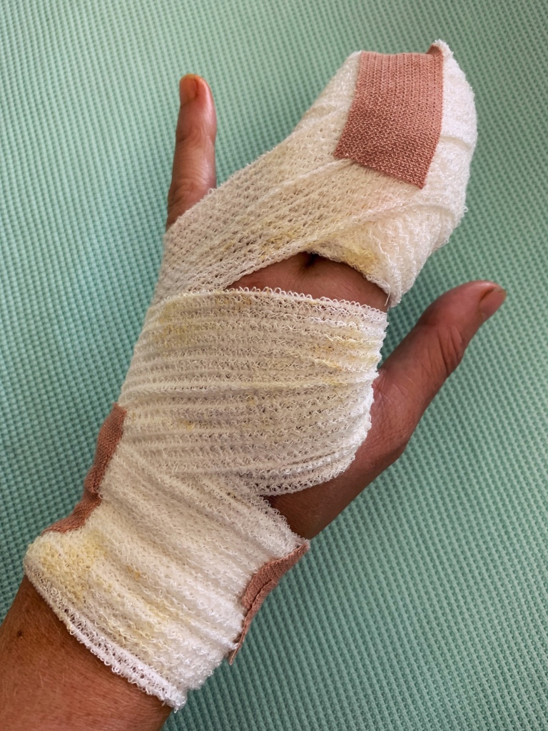 A bandaged hand