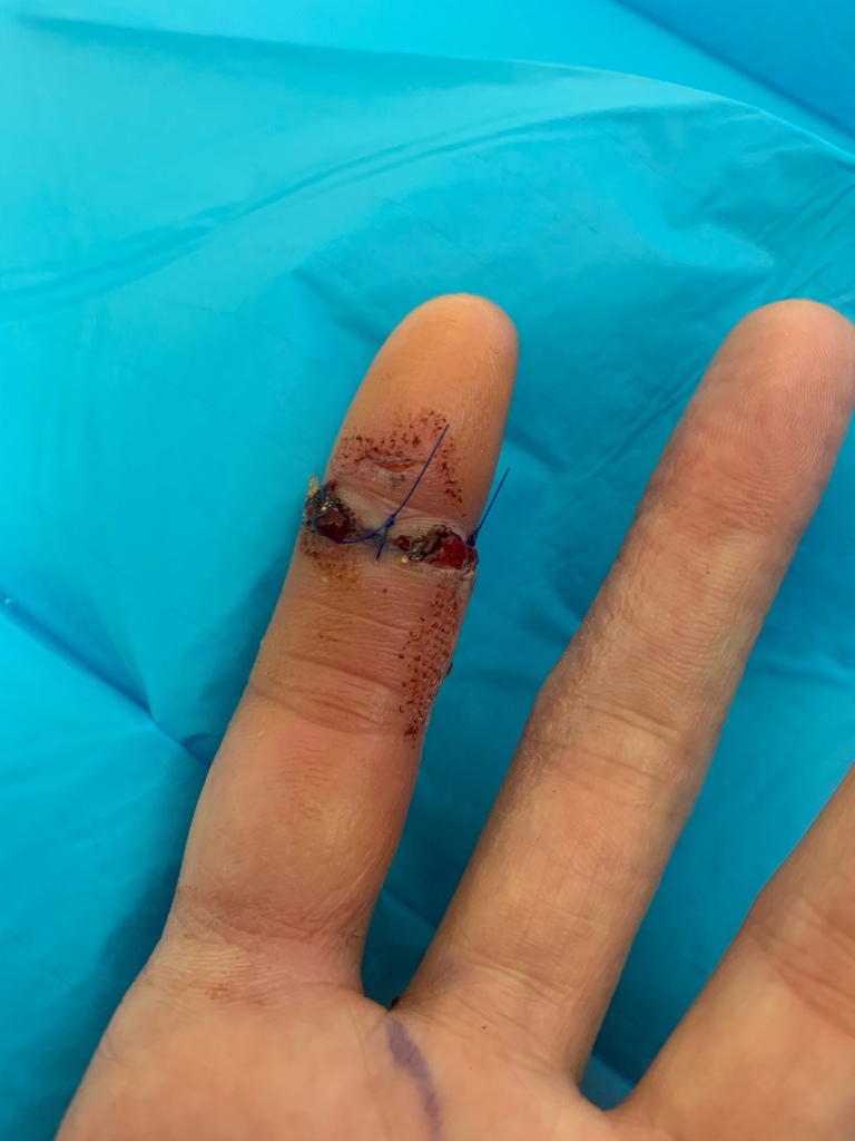 A human index finger with sutures on the palmar aspect