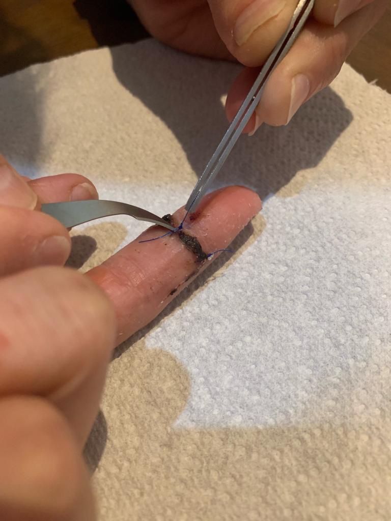 A close up of suture removal with scissors from the palmar aspect of a human index finger