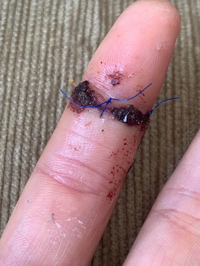 A post op picture of an injured human index finger with 2 sutures on the palmar aspect