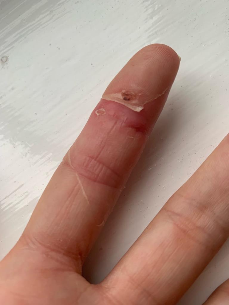 An index finger healing after a cat bite injury