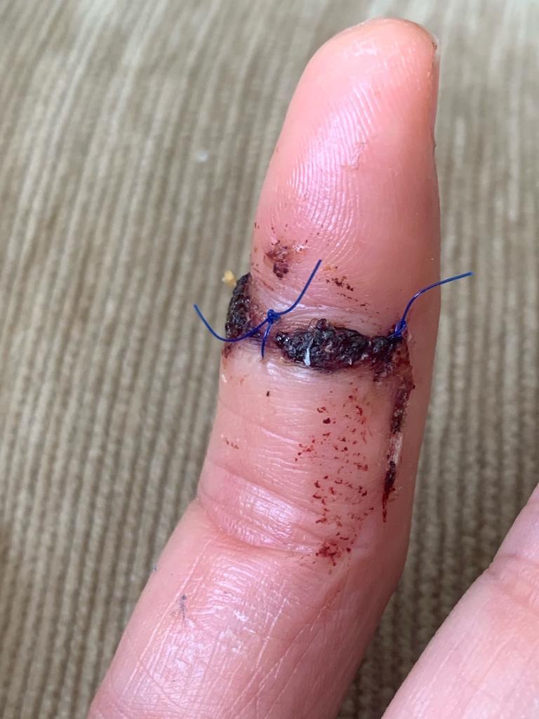 A close up of a post op picture of an injured human index finger with 2 sutures on the palmar aspect
