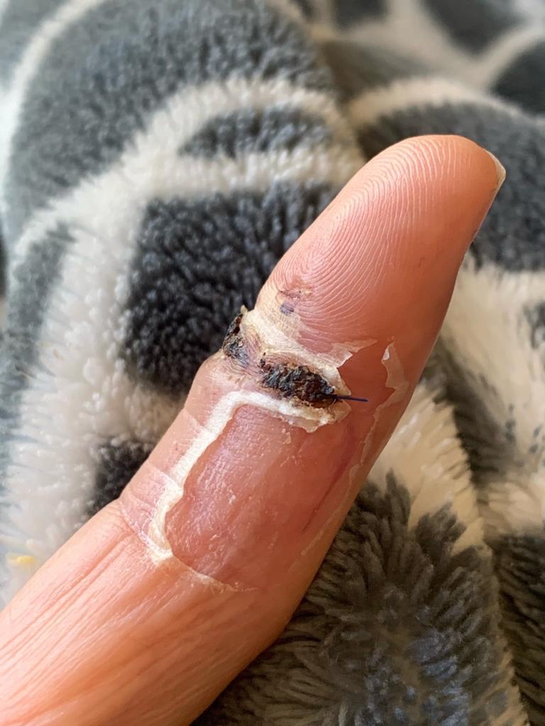 An index finger healing after a cat bite injury