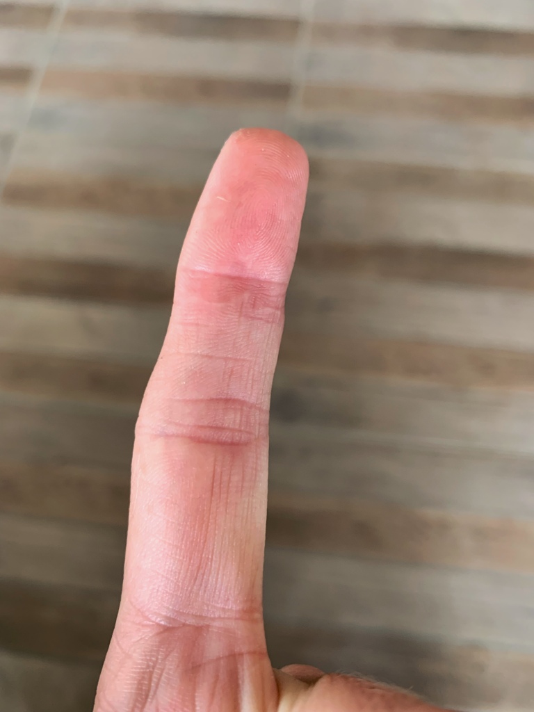 A picture of a twenty four week post-op index finger after being bitten by a cat