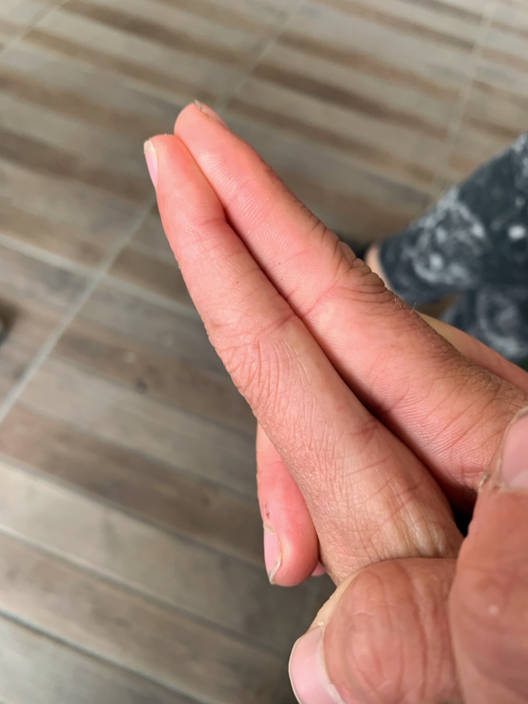 A picture of a twenty four week post-op index finger after being bitten by a cat
